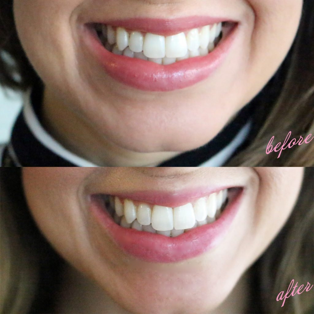 Smile Brilliant Before and After